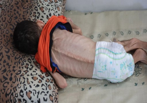 وفاة أربعة أطفال في مستشفى بغزة بسبب الجوع