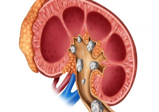 ابتكار عقار طبي لعلاج حصوات الكلى الكبيرة دون تدخل جراحي‎‎