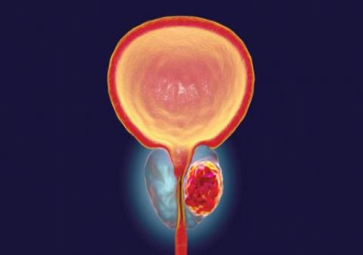 علماء بريطانيون يتوصلون لعلاج خارق لسرطان "البروستات"
